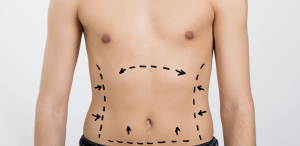 Abdominoplasty in Fairfax Virginia for Excess Skin